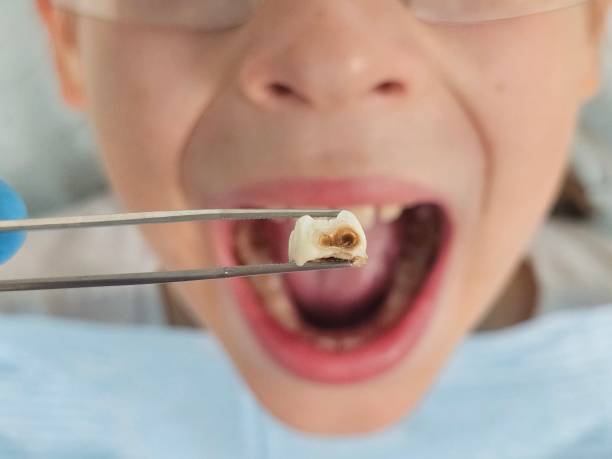 Best Emergency Wisdom Tooth Extraction in Window Rock, AZ